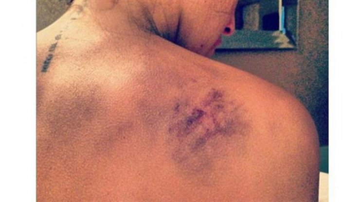 Αποκάλυψε την πλάτη της και είναι γεμάτη μελανιές