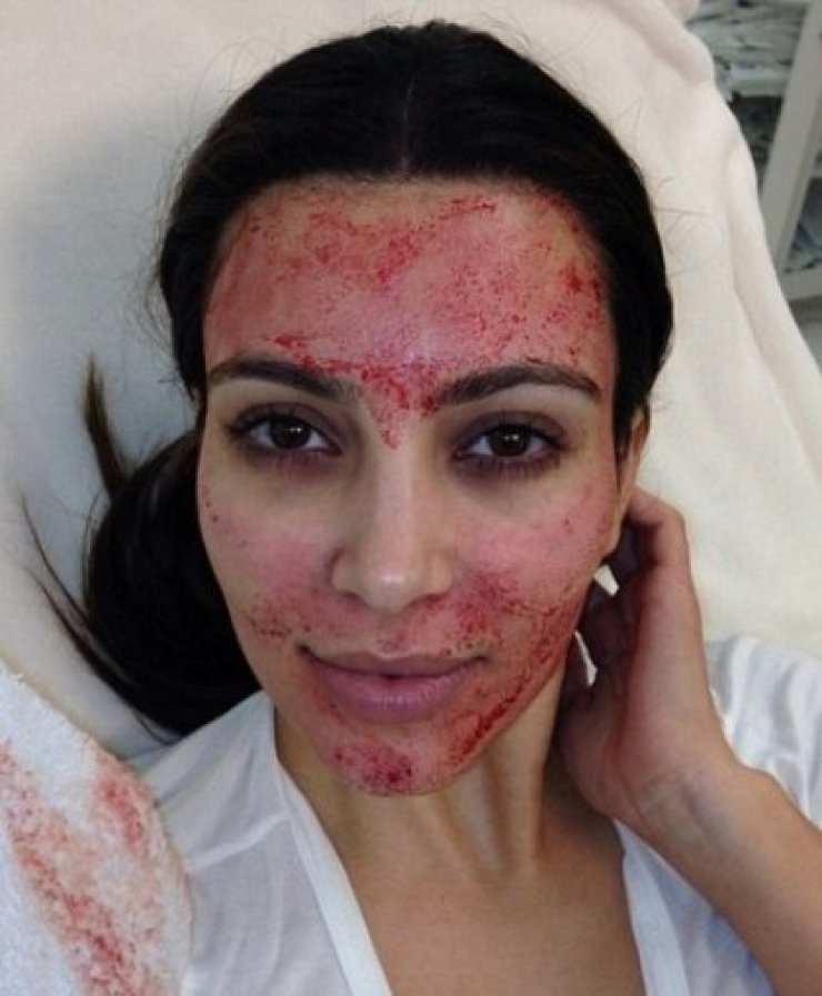Κim Kardashian: Έκανε θεραπεία προσώπου με το ίδιο της το αίμα! 