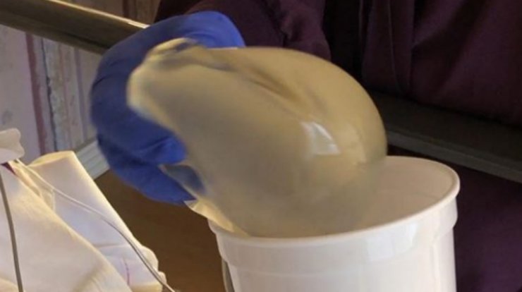 Η πρώην σύζυγος επώνυμου Κύπριου έβγαλε τη σιλικόνη από το στήθος και μας το έδειξε! [εικόνες]