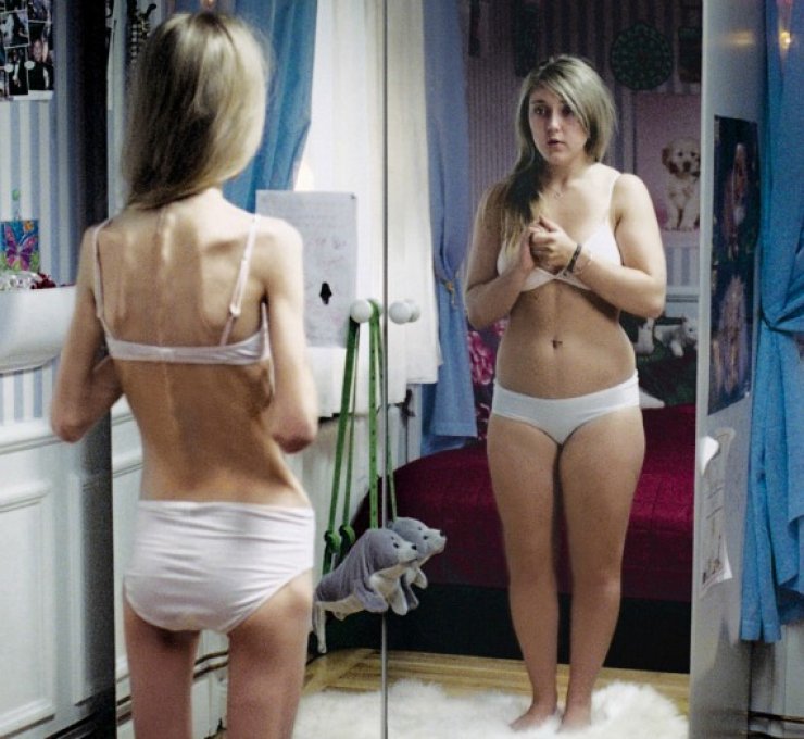 Βρέθηκε η θεραπεία κατά της ανορεξίας