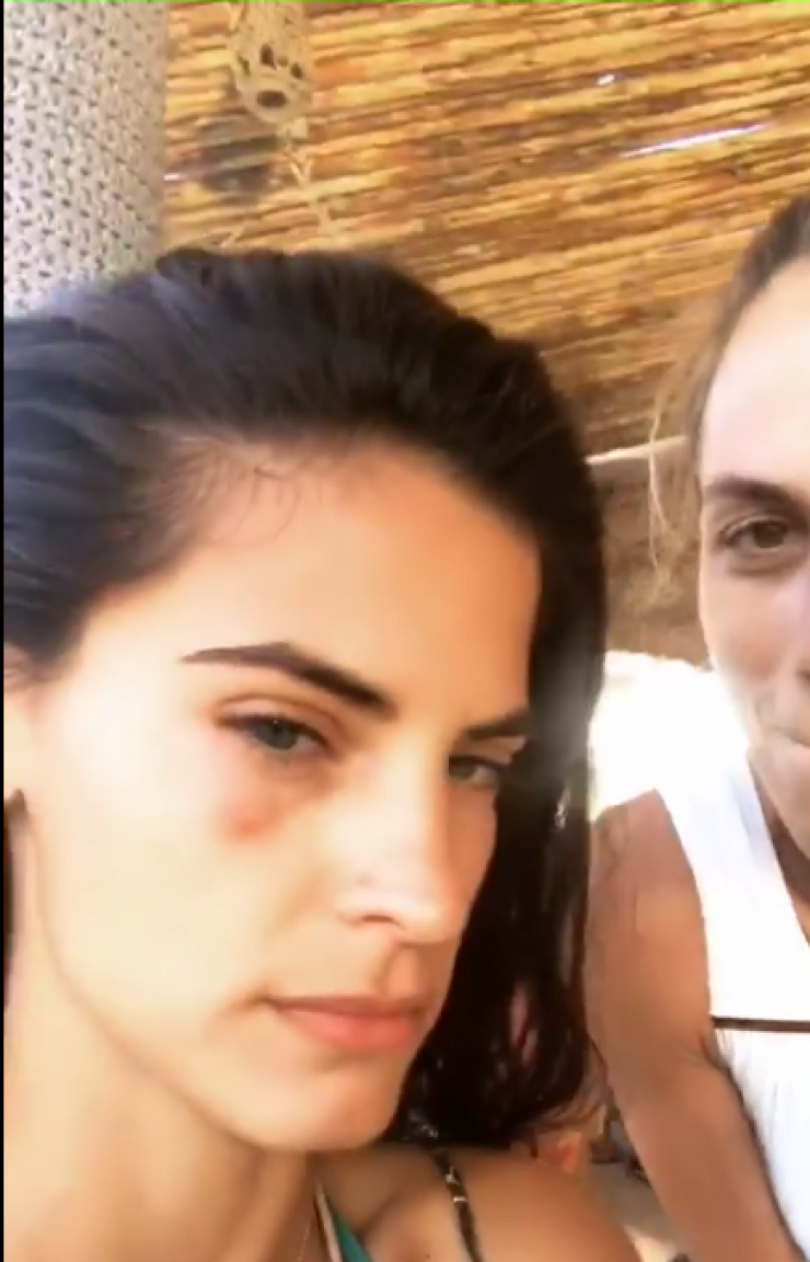 Με χτυπημένο μάτι η σύντροφος του Σάκη Τανιμανίδη στις διακοπές τους!