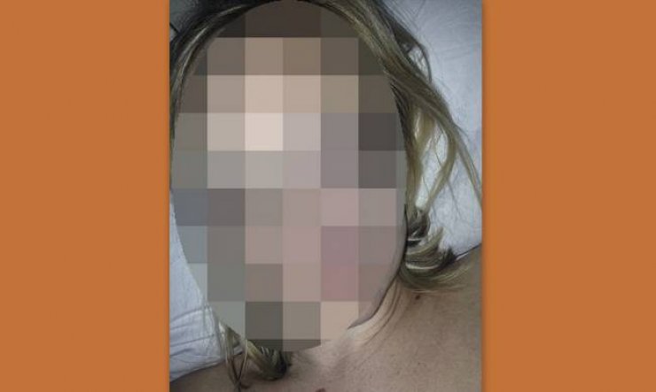 Προσοχή - σκληρό περιεχόμενο: Ηθοποιός τηλεοπτικής σειράς διεγνώσθη με καρκίνο στο δέρμα