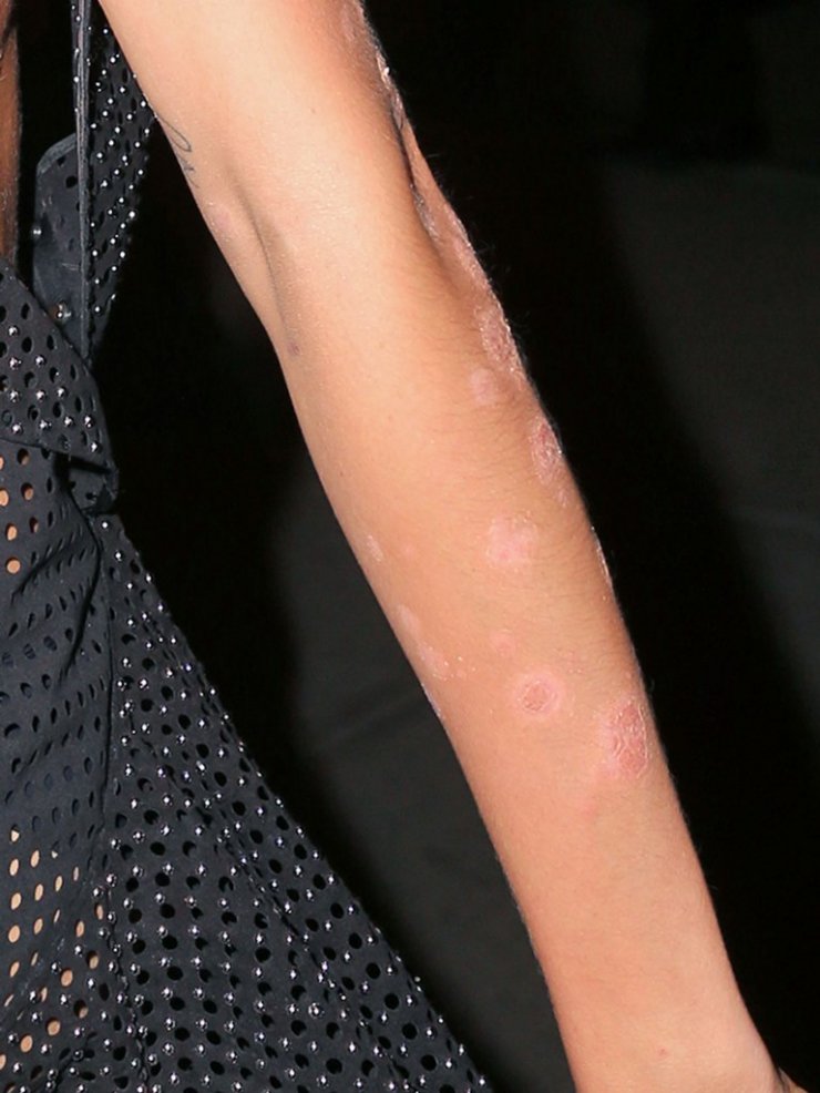 Πασίγνωστο μοντέλο έδειξε για πρώτη φορά τα σημάδια ψωρίασης στο σώμα της!