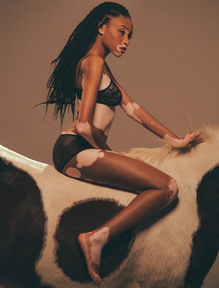 Chantelle Young: Το Next Top Model της Αμερικής έχει λεύκη