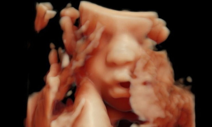 Επώνυμη εγκυμονούσα μας δείχνει σε 3D τον υπέρηχο του μωρού της!