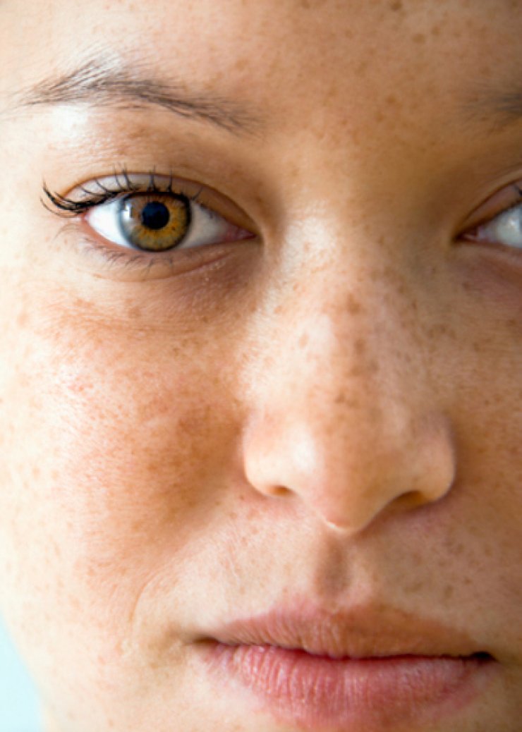 Πως να αντιμετωπίσεις τις πανάδες