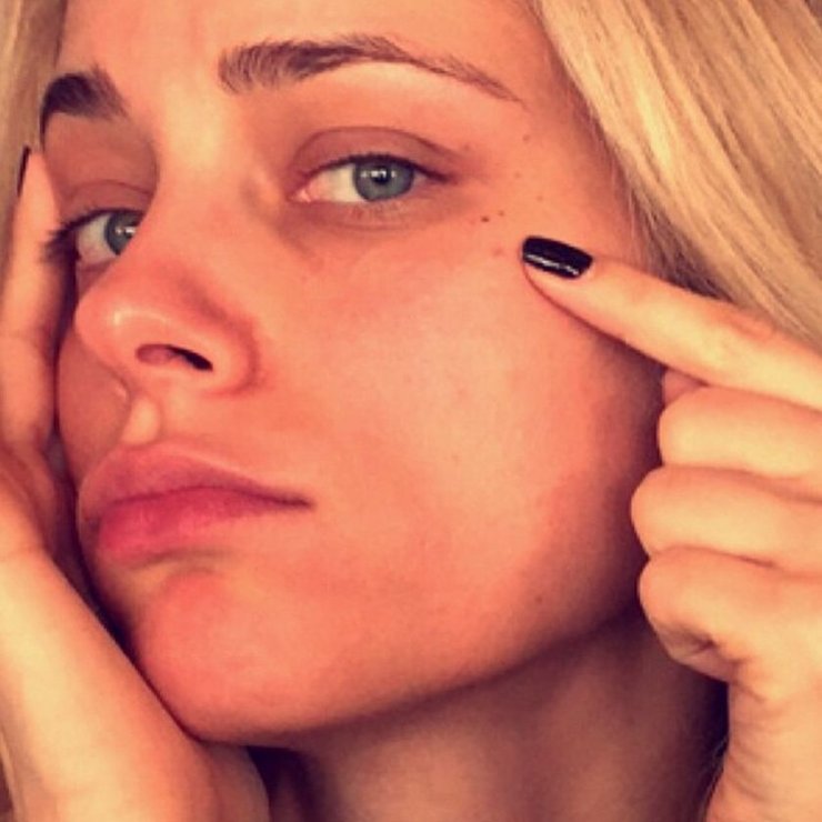 Η μαγική συνταγή για να αντιμετωπίσεις ένα ξαφνικό σπυράκι!