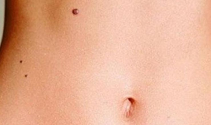 Ύποπτες ελιές: Τα 4 σημάδια που πρέπει να προσέξετε 