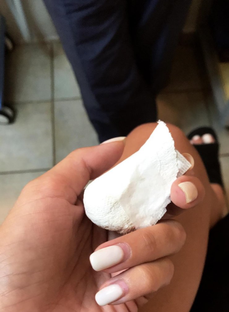 Επώνυμη Ελληνίδα έκανε πλαστική στη μύτη και μας δείχνει τη νέα της εικόνα!