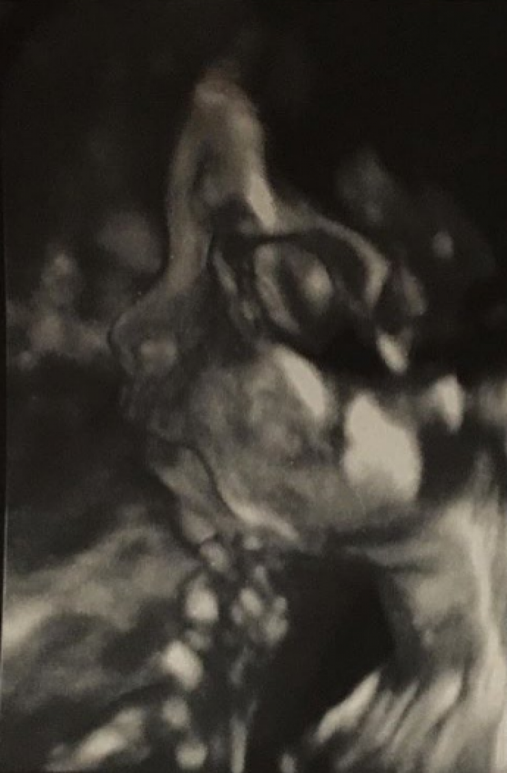 Διάσημο ζευγάρι χώρισε λίγο πριν φέρει στη ζωή το πρώτο του παιδάκι!