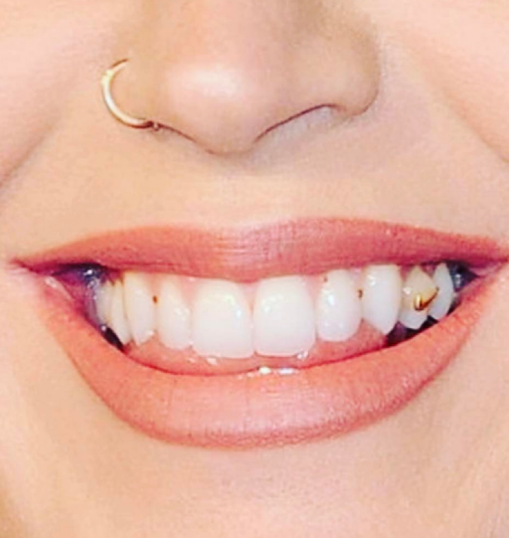 Απίστευτο κι όμως συνέβη! Πασίγνωστη τραγουδίστρια κυκλοφόρησε δημόσια με ακαθαρσίες στα δόντια!