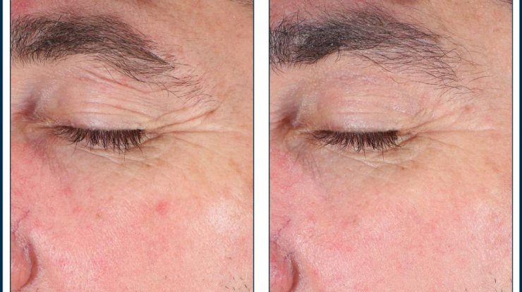 Το νέο προϊόν της Skinbetter Science, EyeMax AlphaRet Overnight Cream υπόσχεται να σας καταπλήξει!