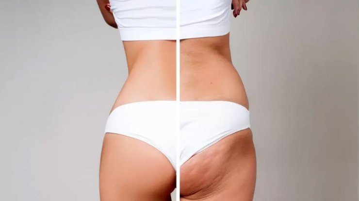 Εννέα τροφές που προκαλούν κυτταρίτιδα