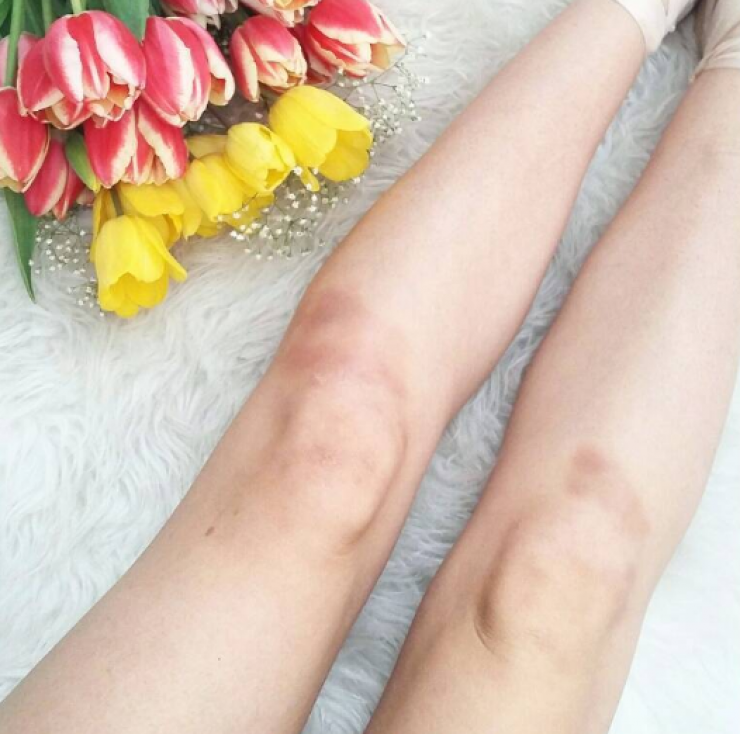 Επώνυμη Κύπρια με μώλωπες στα πόδια!