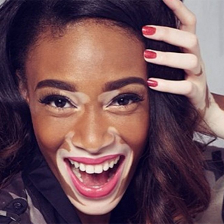 Η 19χρονη καλλονή με τη λεύκη που μεσουρανεί στις πασαρέλες [εικόνες]