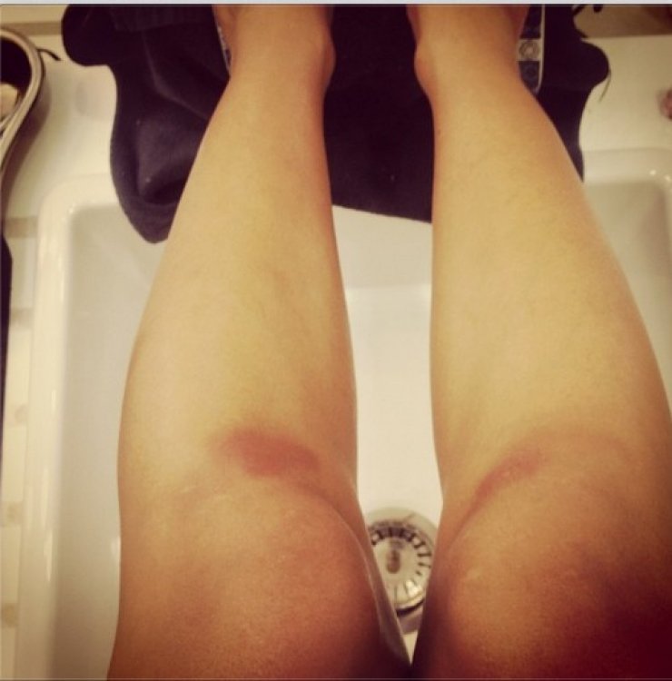 Ποια επώνυμη Κύπρια εμφανίστηκε με μελανιές στα πόδια…