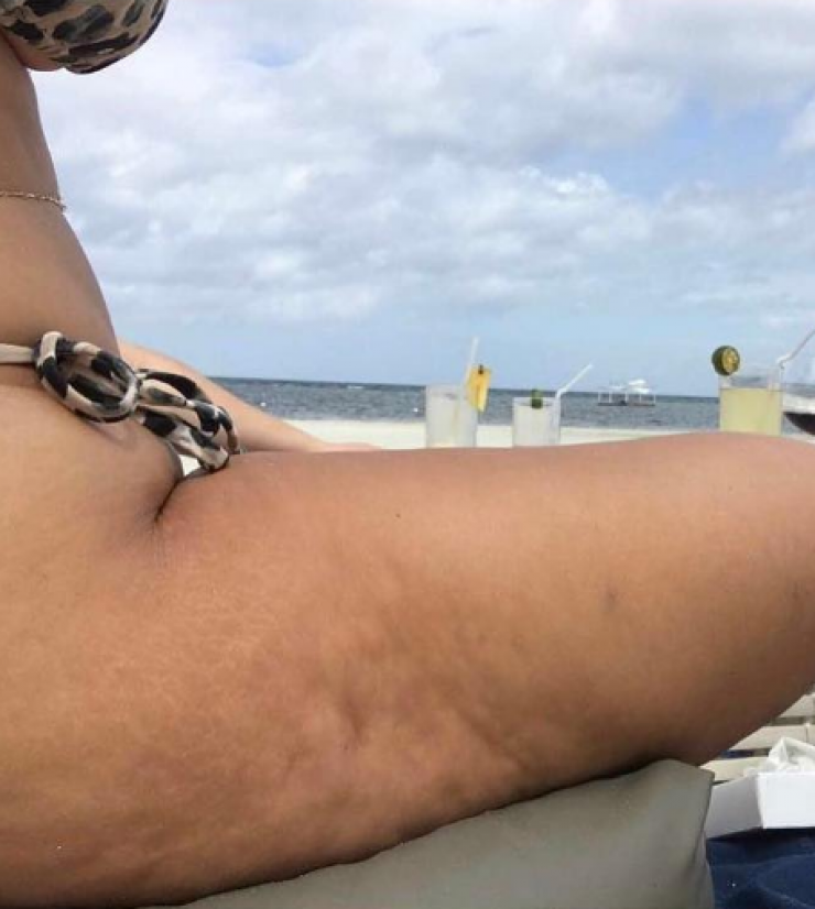 Η φωτογραφία επώνυμης Κύπριας στο instagram με την κυτταρίτιδα!