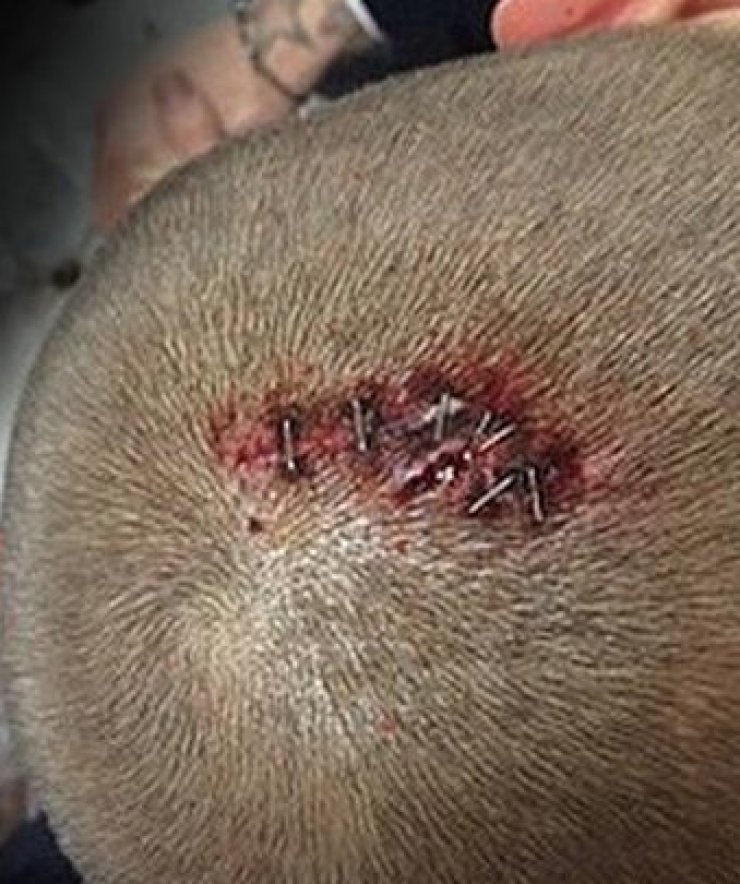 Γνωστός ποδοσφαιριστής σόκαρε τους πάντες όταν ανέβασε στο instagram τα ράμματα που έκανε στο κεφάλι του!