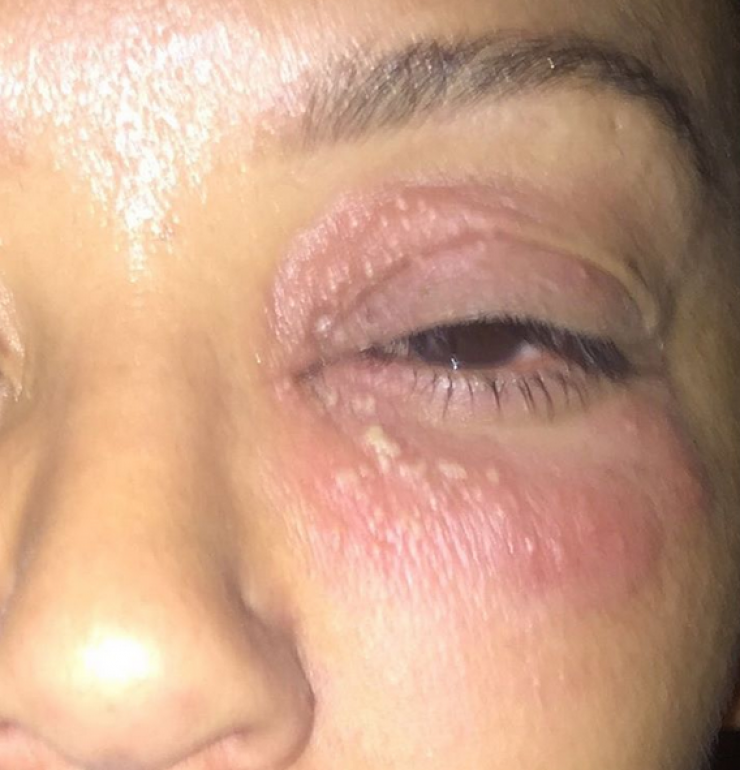 Τι συνέβη στο μάτι πασίγνωστης τραγουδίστριας;