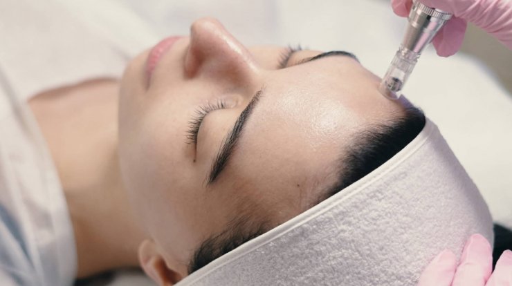 Μεσοθεραπεία: Απόκτησε σφριγηλή και λαμπερή επιδερμίδα λίγο πριν τις γιορτές