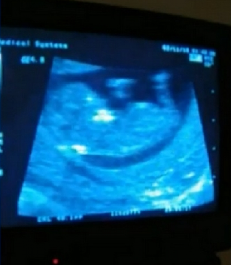 Επώνυμη Ελληνίδα περιμένει το πρώτο της μωράκι!