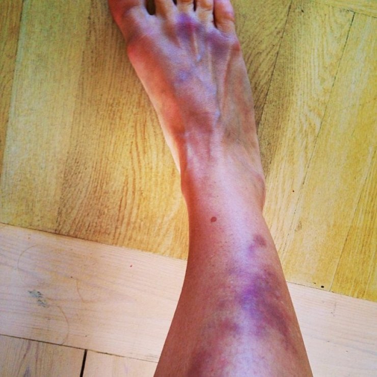 Με μελανιασμένο πόδι Ελληνίδα παρουσιάστρια