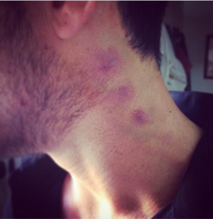 Ηθοποιός του Μπρούσκο με πιπιλιά στον λαιμό