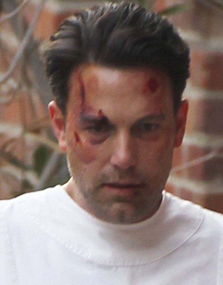 Σοβαρά τραυματισμένος ο Ben Affleck [εικόνες]