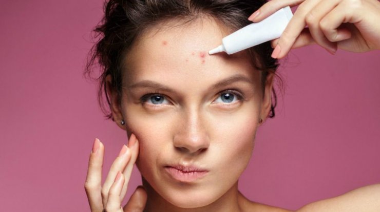 Τι μπορεί να δείχνει για την υγεία σου το σημείο του προσώπου που βγάζεις σπυράκια