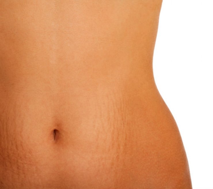 Ραγάδες: Τι είναι και γιατί δεν μας εγκαταλείπουν