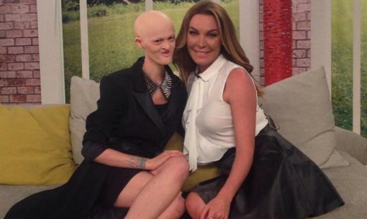 Το μοντέλο που πάσχει από βαμπιρισμό στην Τατιάνα: "Δεν έχω μαλλιά και δόντια λόγω της ασθένειάς μου"