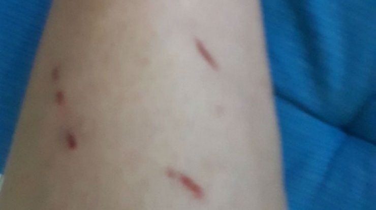 Ο τραυματισμός Κύπριας ηθοποιού μετά από επίθεση!