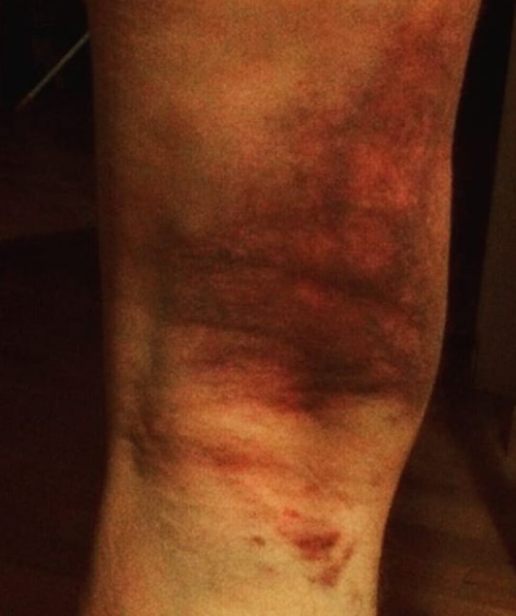 Σοκαριστικός τραυματισμός για επώνυμο Έλληνα!