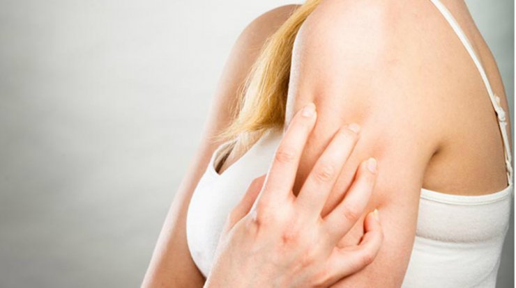 Τέσσερα πράγματα που πρέπει να κάνεις όταν σε τσιμπήσει κουνούπι