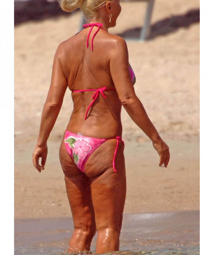 Η κυτταρίτιδα έφτασε μέχρι τον λαιμό! 