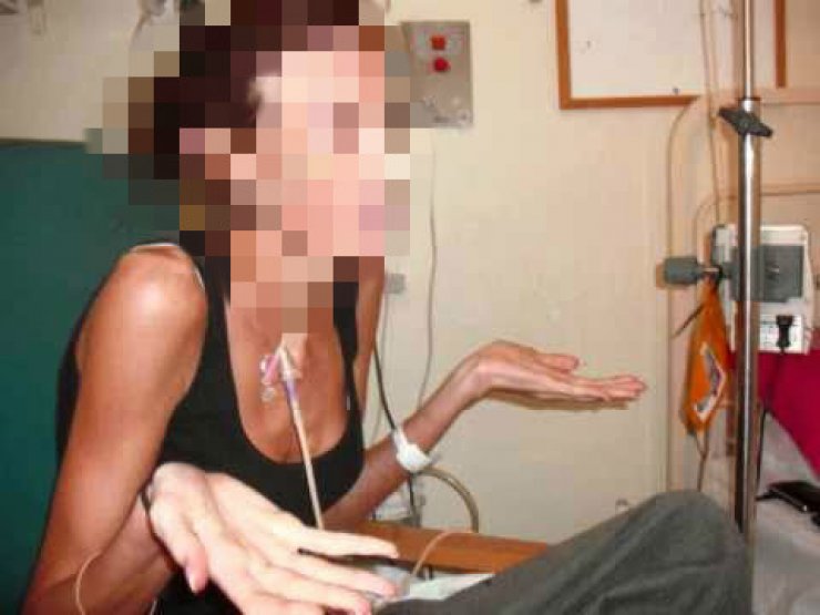 H Νανά νικήθηκε από την ανορεξία