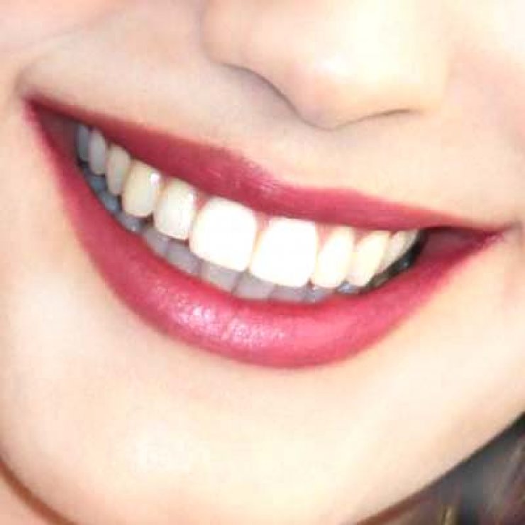 Τέλειο χαμόγελο