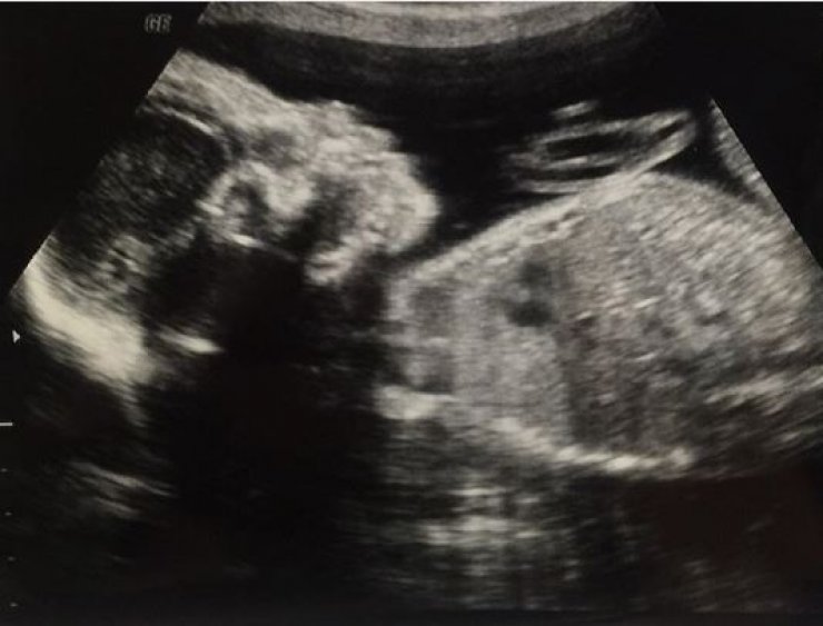 Έμαθαν το φύλο του μωρού τους και ανακοίνωσαν το όνομα μαζί με τον υπέρηχο