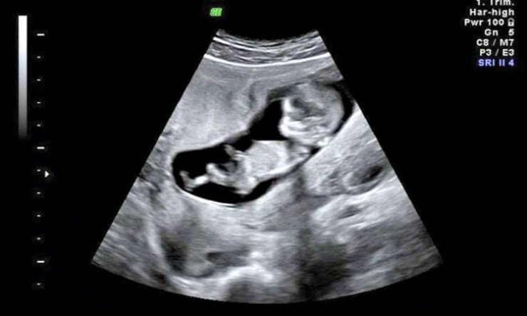 Ελληνίδα ηθοποιός ανακοίνωσε την εγκυμοσύνη της αναρτώντας τον υπέρηχο στο facebook!